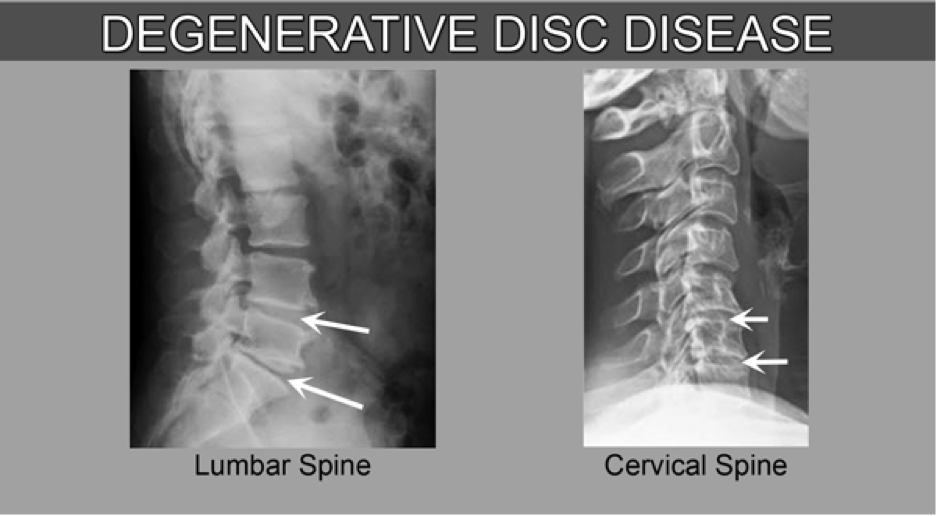 Degenerative Disc Disease