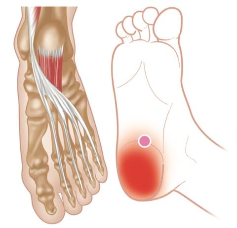 Plantarfascia